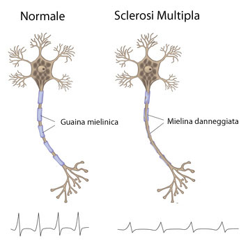 Sclerosi Multipla Mielina